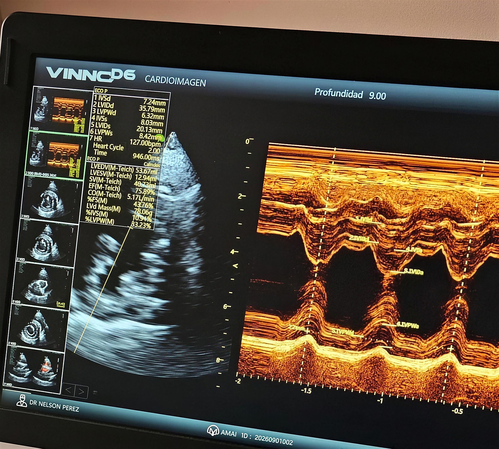 Trazado real en modo M de una ecocardiografía realizada en CardioImagen